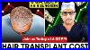 Live Q U0026a How Much Does A Hair Transplant Cost By Hair Surgeon Dr Satya Saraswat